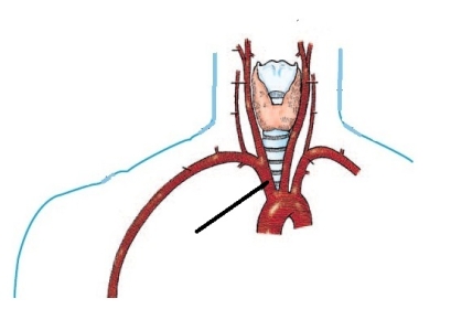 The artery identified in the figure below is the:   A)  brachiocephalic. B)  left subclavian. C)  right subclavian. D)  right common carotid.