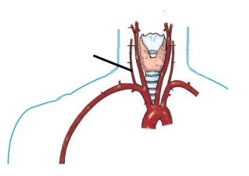The artery identified in the figure below is the:   A)  left vertebral. B)  right vertebral. C)  right common carotid. D)  left internal carotid.