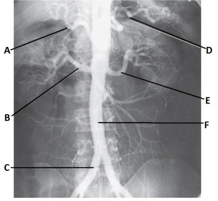 Letter B in the abdominal aortogram image below is the _____ artery.   A)  splenic B)  celiac C)  R renal D)  hepatic