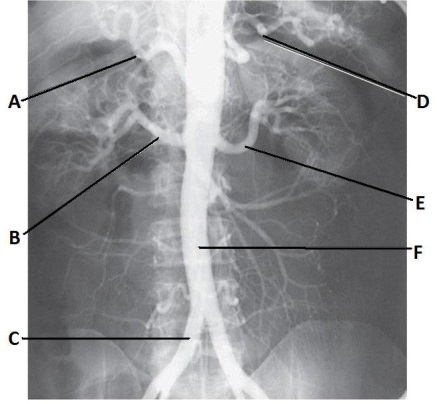 Letter C in the abdominal aortogram image below is the:   A)  R common iliac artery. B)  abdominal aorta. C)  R femoral artery. D)  gonadal artery.