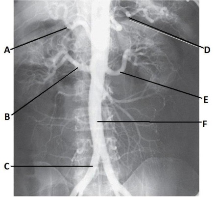 Letter E in the abdominal aortogram image below is the _____ artery.   A)  hepatic B)  splenic C)  L renal D)  superior mesenteric