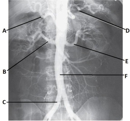 Letter F in the abdominal aortogram image below is the:   A)  abdominal aorta B)  common iliac artery C)  superior mesenteric artery D)  inferior mesenteric artery