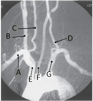 Letter B in the angiographic image of the aortic arch and its branches below is the _____ artery.   A)  innominate (brachiocephalic)  B)  R common carotid C)  R subclavian D)  R vertebral