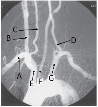 Letter C in the angiographic image of the aortic arch and its branches below is the _____ artery.   A)  innominate (brachiocephalic)  B)  R common carotid C)  R subclavian D)  R vertebral
