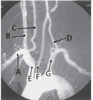 Letter D in the angiographic image of the aortic arch and its branches below is the _____ artery.   A)  innominate (brachiocephalic)  B)  L common carotid C)  L subclavian D)  L vertebral