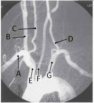Letter E in the angiographic image of the aortic arch and its branches below is the _____ artery.   A)  innominate (brachiocephalic)  B)  L common carotid C)  L subclavian D)  L vertebral