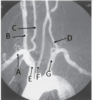 Letter F in the angiographic image of the aortic arch and its branches below is the _____ artery.   A)  innominate (brachiocephalic)  B)  L common carotid C)  L subclavian D)  L vertebral