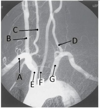 Letter G in the angiographic image of the aortic arch and its branches below is the _____ artery.   A)  innominate (brachiocephalic)  B)  L common carotid C)  L subclavian D)  L vertebral