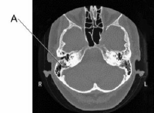 Line A is pointing to the:   A)  cochlea. B)  inner ear. C)  mastoid air cells. D)  internal auditory canal.