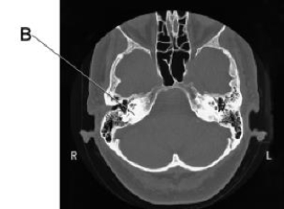 Line B is pointing to the:   A)  inner ear. B)  tympanic membrane. C)  internal auditory canal. D)  petrous portion of the temporal bone.