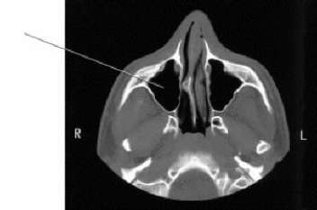 The line on this CT scan of the facial bones identifies the _____ sinus.   A)  maxillary B)  sphenoid C)  middle ethmoid D)  posterior ethmoid