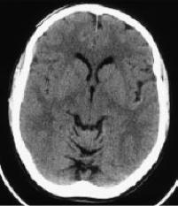This CT image of the brain is in which plane?   A)  Axial B)  Coronal C)  Sagittal D)  Midsagittal