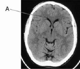 Line A is pointing to the _____ in this CT image of the brain.   A)  choroid plexus B)  third ventricle C)  lateral ventricle, anterior horn D)  lateral ventricle, occipital horn