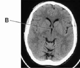 Line B is pointing to the _____ in this CT image of the brain.   A)  pituitary gland B)  third ventricle C)  lateral ventricle D)  foramen of Monroe