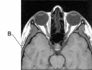 Line B is pointing to the:   A)  pons. B)  cerebellum. C)  frontal lobe. D)  temporal lobe.