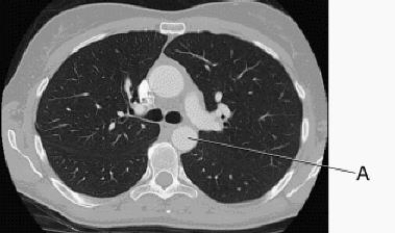 In this cross section of the thorax, line A identifies the:   A)  bronchus. B)  esophagus. C)  ascending aorta. D)  descending aorta.