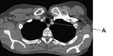 Line A in this axial CT scan identifies the left:   A)  clavicle. B)  brachiocephalic vein. C)  subclavian artery. D)  subclavian vein.