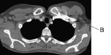 Line B in this axial CT scan identifies the left:   A)  clavicle. B)  brachiocephalic vein. C)  subclavian artery. D)  subclavian vein.