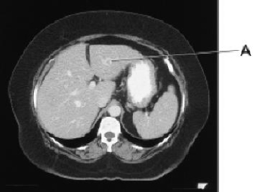 Line A on this image is pointing to the:   A)  right lobe of the liver. B)  left lobe of the liver. C)  caudate lobe of the liver. D)  falciform ligament.