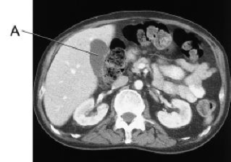 Line A on this image is pointing to the:   A)  liver. B)  spleen. C)  L kidney. D)  gallbladder.
