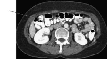The line on this CT scan is pointing to the:   A)  liver. B)  sternum. C)  stomach. D)  transverse colon.