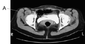 Line A on this CT scan is pointing to the:   A)  uterus. B)  rectum. C)  bladder. D)  small bowel.