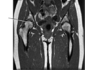 The line on this image of the pelvis identifies the:   A)  humerus. B)  glenoid cavity. C)  acetabulum. D)  greater trochanter.