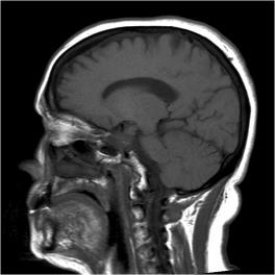 The plane on this image is a(n) :   A)  coronal. B)  axial. C)  sagittal. D)  midcoronal.
