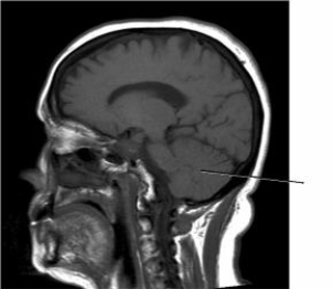 The line on the image below points to the:   A)  occipital lobe. B)  temporal lobe. C)  pons. D)  cerebellum.