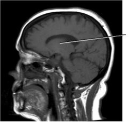 On the image below, the line points to the structure that forms the walls of the third ventricle, which is the:   A)  pons. B)  thalamus. C)  lateral ventricle. D)  cerebellar peduncles.