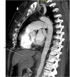 Examine the image below. The line points to the:   A)  stomach. B)  liver. C)  kidney. D)  heart.