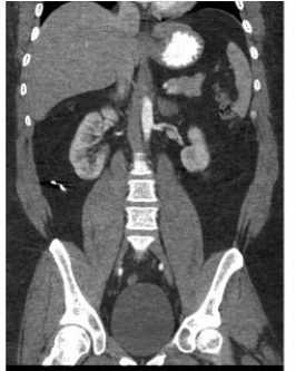 Which of the following organs are demonstrated in the image below? 1) Spleen 2) Kidneys 3) Pancreas   A)  1 and 2 B)  1 and 3 C)  2 and 3 D)  1, 2, and 3