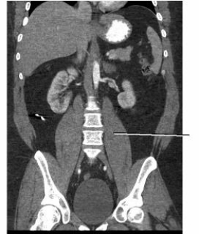 Examine the image below. The line points to the _____ muscle.   A)  left psoas B)  right psoas C)  rectus abdominis D)  external oblique