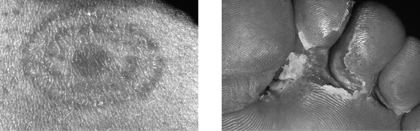 What type of infection is shown?   A)  candidiasis B)  subcutaneous mycoses C)  tinea D)  impetigo E)  leishmaniasis