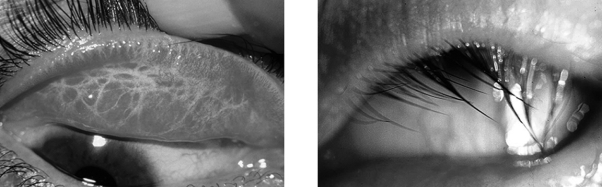 While on a medical volunteer trip to an impoverished country, you encounter a patient whose eyelids are turned inward as shown. What is the cause and the best treatment?   A)  neonatal bacterial conjunctivitis; antibiotic or silver drops should have been given at birth B)  onchocerciasis (river blindness) ; doxycycline C)  viral conjunctivitis; no treatment but the condition will resolve with time D)  Acanthamoeba; corneal transplant will likely be necessary E)  trachoma; single dose of oral azithromycin
