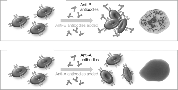 According to the agglutination tests pictured below, what is the blood type of the sample being tested?   A)  A B)  B C)  O D)  AB E)  Could be either A or B
