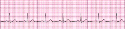 Identify the following rhythm (lead II): ____________________   