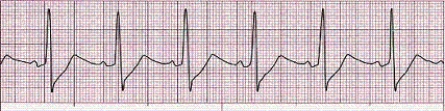 Identify the following rhythm (lead II): ____________________   