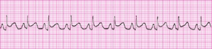 Identify the following rhythm (lead II): ____________________   
