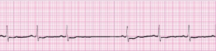 Identify the following rhythm (lead II): ____________________   