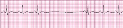 Identify the following rhythm (lead II): ____________________   