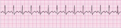 Identify the following rhythm (lead II): ____________________   