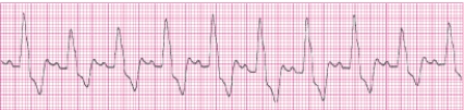 Identify the following rhythm (lead II): ____________________   
