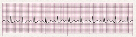 Identify the following rhythm (lead II): ____________________   