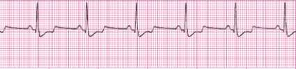 Identify the following rhythm (lead II): ____________________   