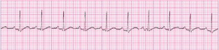 Identify the following rhythm (lead II): ____________________   