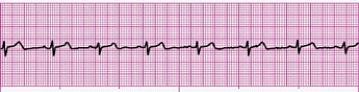 Identify the following rhythm (lead II): ____________________   