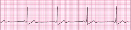 Identify the following rhythm (lead II): ____________________   