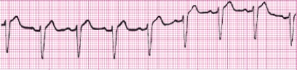 Identify the following rhythm (lead II): ____________________   