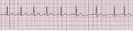 Identify the following rhythm (lead II): ____________________   